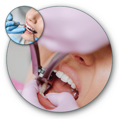 endodontia-canal